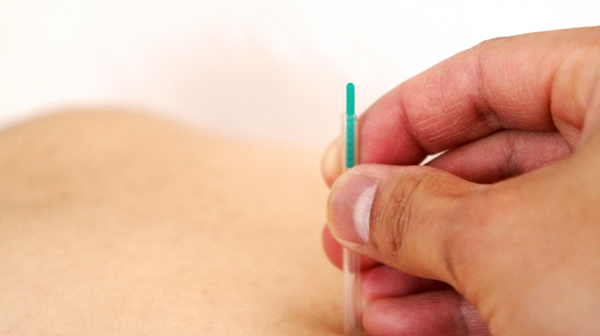 鍼の施術の様子