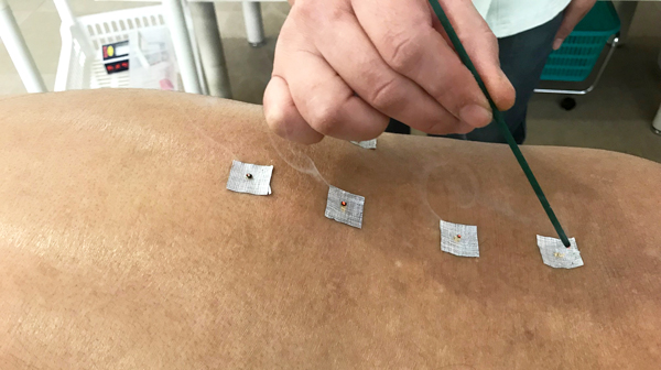 灸の施術の様子